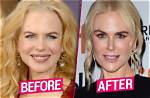 Nicole Kidman: the Facelift Journey of a Hollywood Icon
